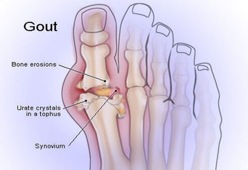 About gout