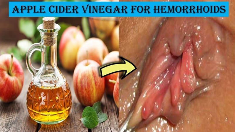 Apple cider vinegar for hemorrhoids