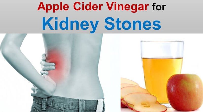 Apple cider vinegar for kidney stones