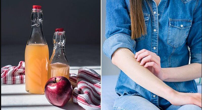 Can apple cider vinegar help with eczema