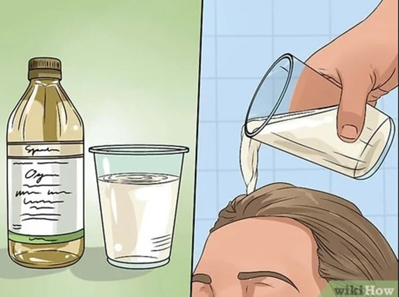 How To Utilize Apple Cider Vinegar For Dandruff
