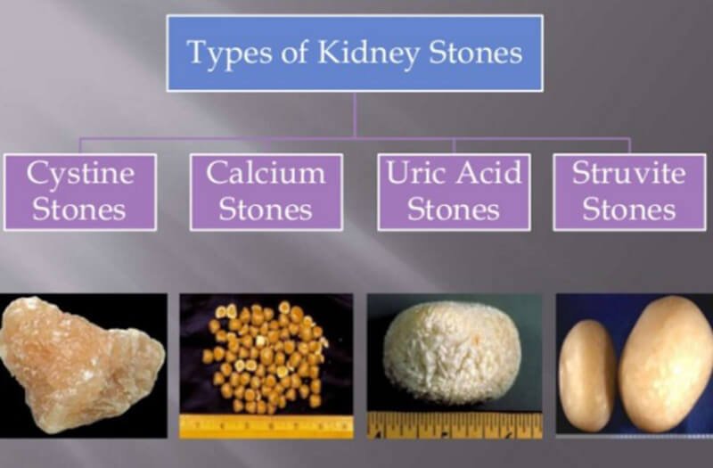 Types of kidney stones
