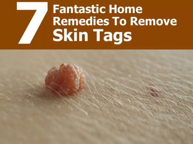 Ways to Remove Skin Tags