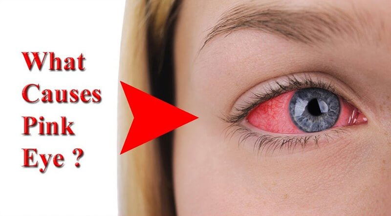 What causes pink eye