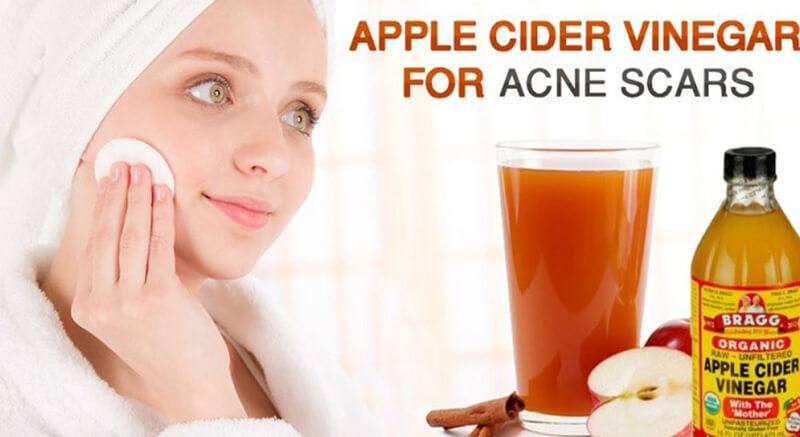 Apple cider vinegar for acne scars