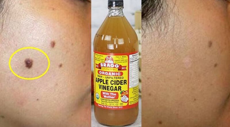 apple cider vinegar for moles