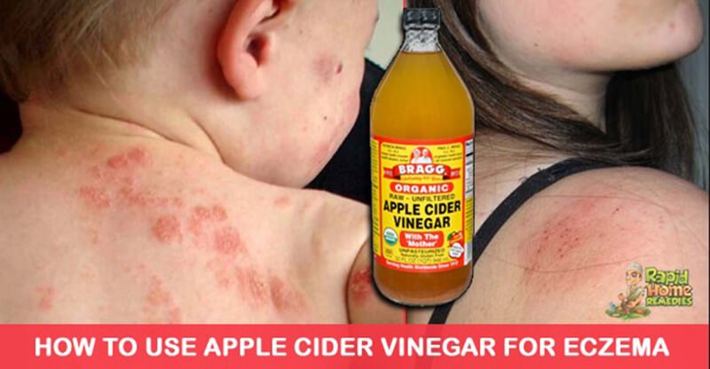 how to use apple cider vinegar for eczema
