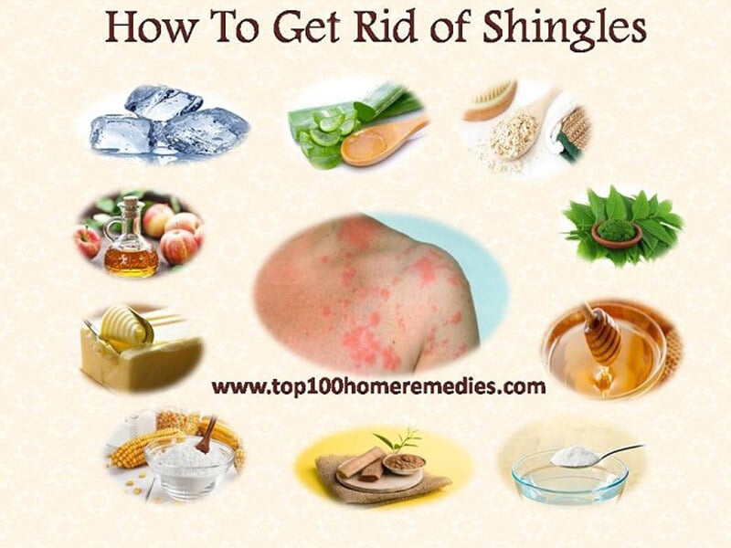 remedies for shingles