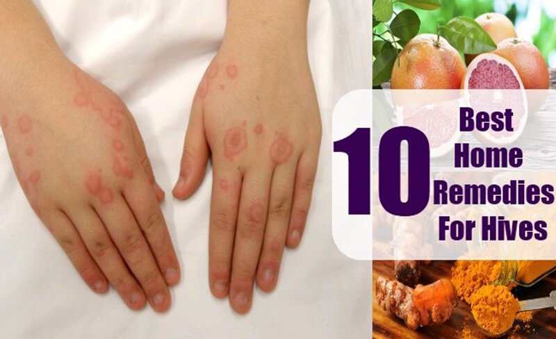 All-natural home remedies for hives