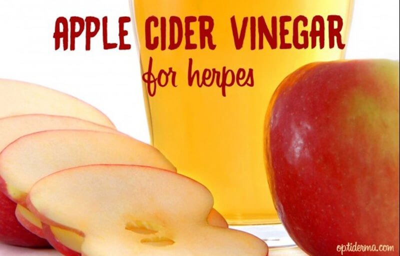 Apple Cider Vinegar For Herpes