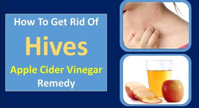 Apple Cider Vinegar For Hives