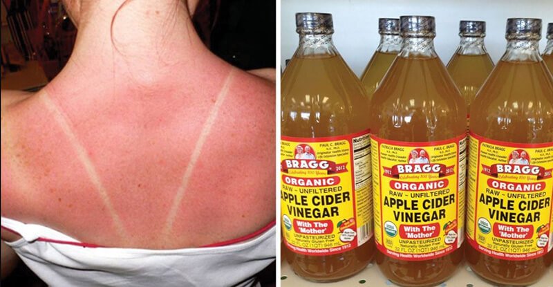 Apple Cider Vinegar For Sunburn