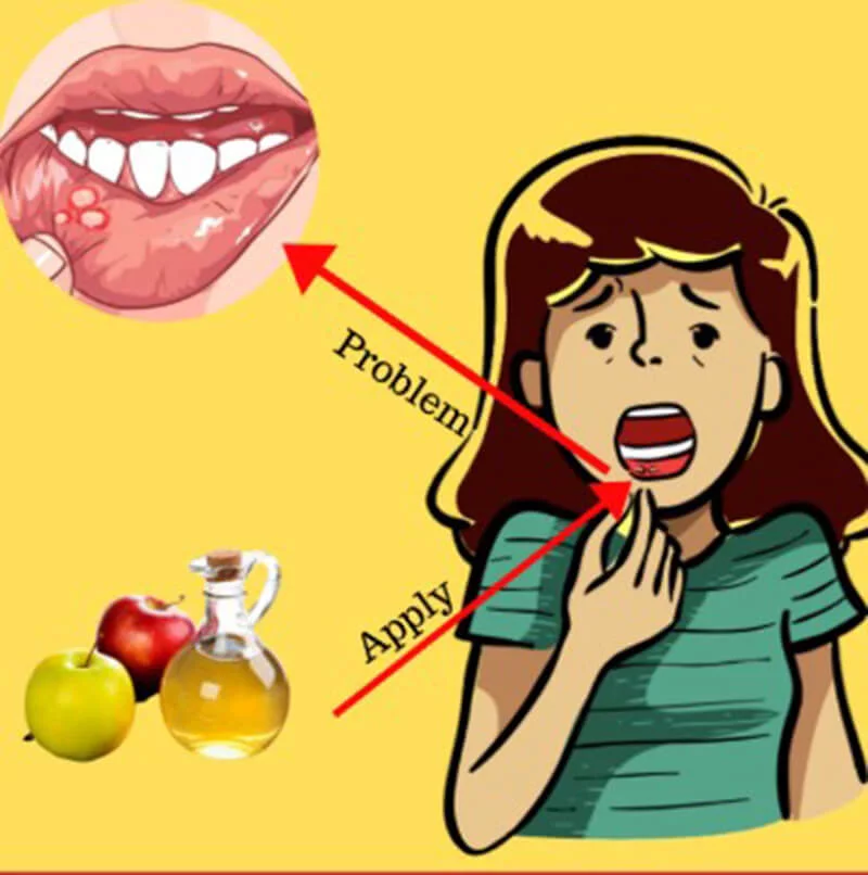 Vinagre de sidra de manzana para úlceras