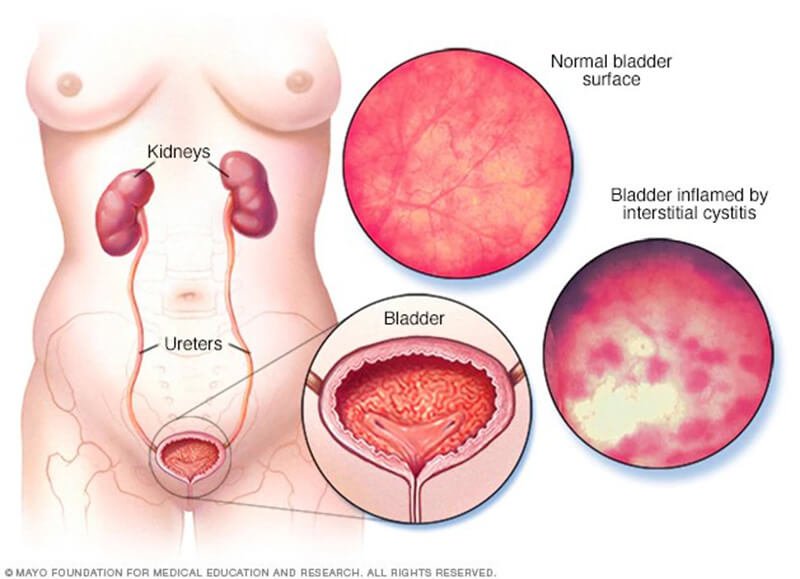 What is Interstitial Cystitis