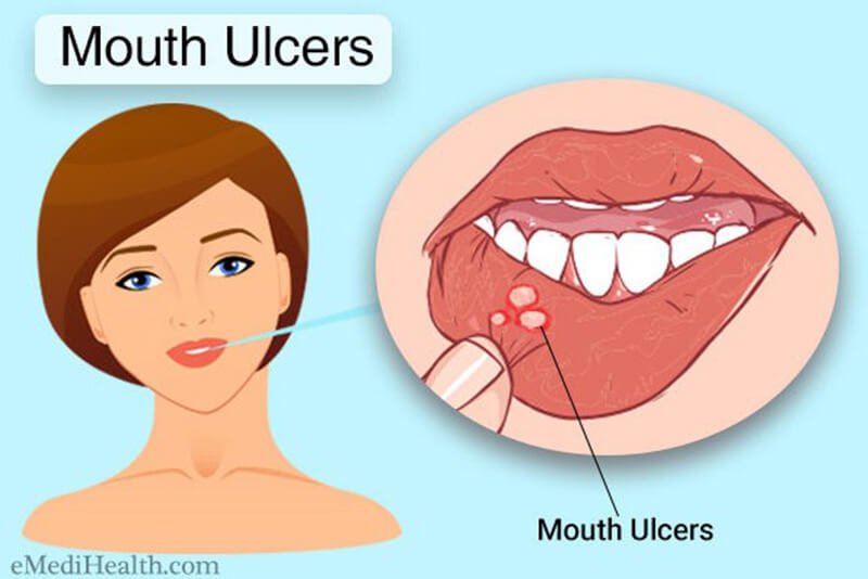 home treatment for mouth ulcers