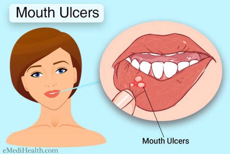 tratamento doméstico para úlceras da boca
