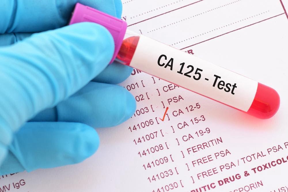 ca 125 cancer test - very high ca 125 levels