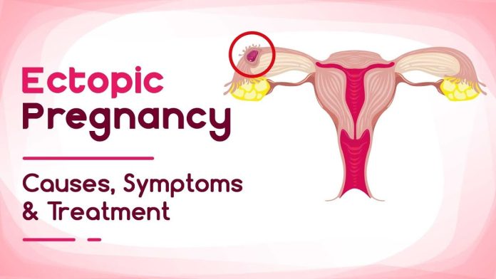Signs Of Ectopic Pregnancy