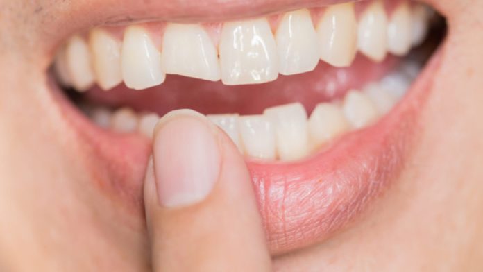 Advantages of Teeth Whitening