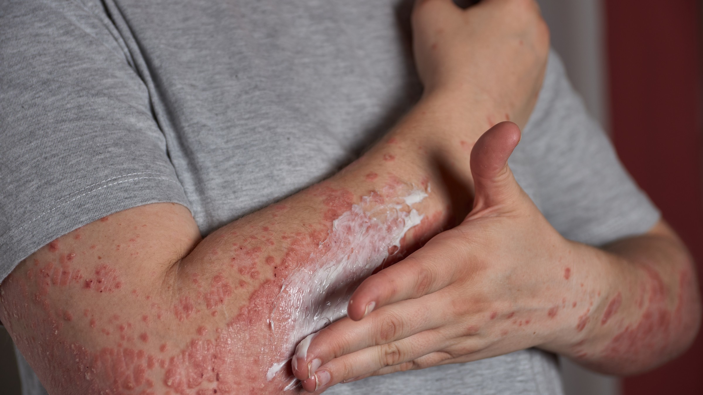 how to cure psoriasis permanently