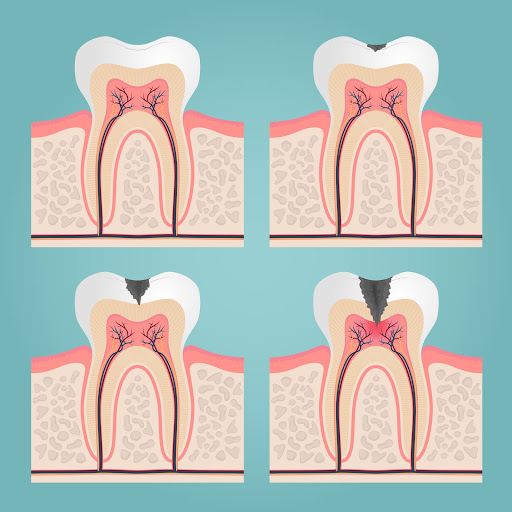 how to cure gum disease without a dentist